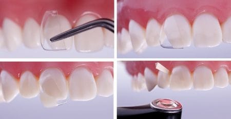 CoForm Clinical Tips Image 1