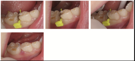 FenderMate Prime Clinical Cases Image 2