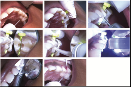 FenderMate Prime Clinical Cases Image 3 