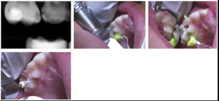 FenderMate Prime Clinical Cases Image 4