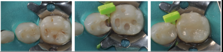 FenderMate Prime Clinical Cases Image 5