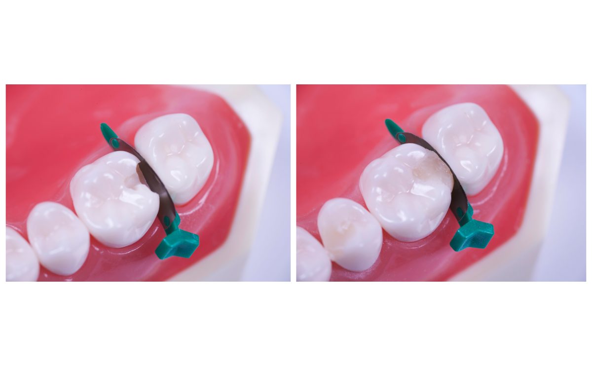 FenderMate Technique In tooth