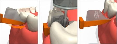 FenderWedge Clinical Tips Image 4